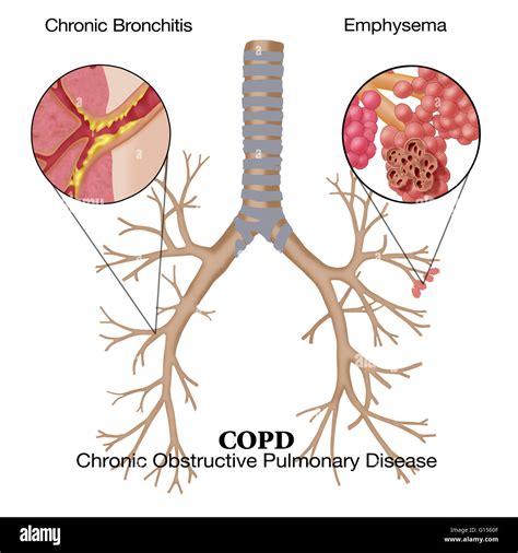 Chronic Obstructive Pulmonary Disease Copd Clinical Symptoms Emerging Treatment Strategies And Impact On Quality