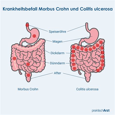 chronische darmkrankheit morbus crohn