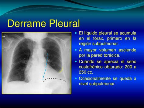 Cid Derrame Pleural