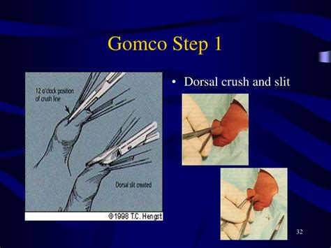 Circumcision Gomco Procedure Note
