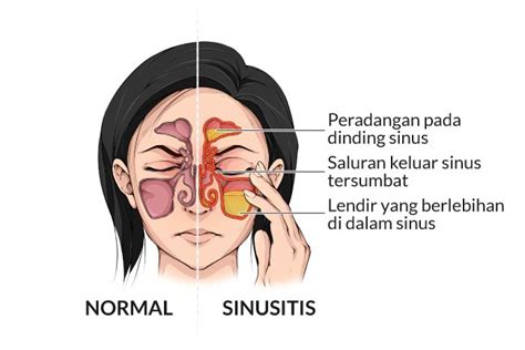 ciri ciri sinusitis