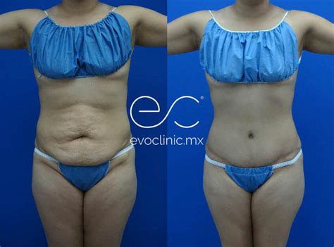 cirugia de tummy tuck