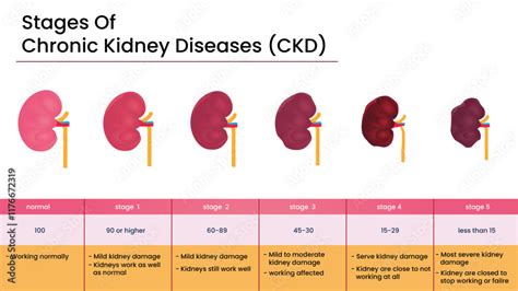 Ckd Stage Chart
