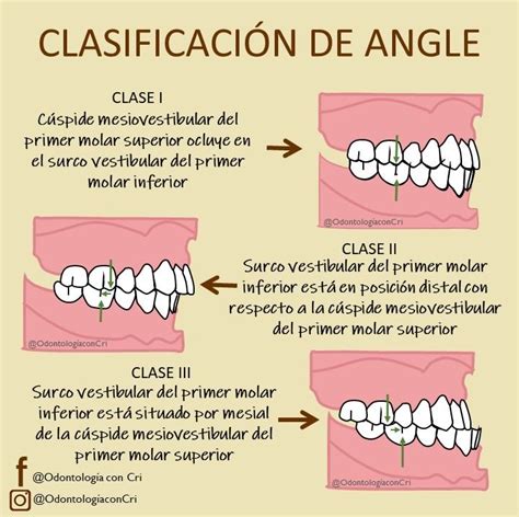 Clasificacion De Angle