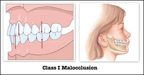 Class 1 Molar Relationship