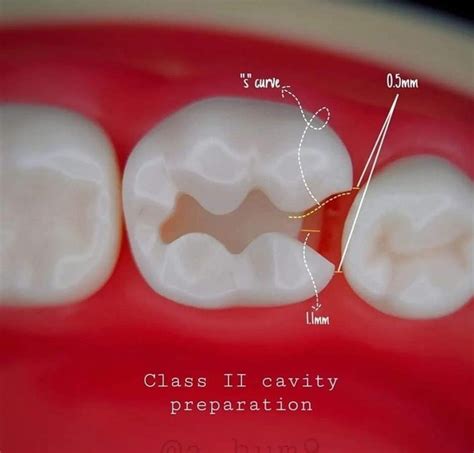 Class 2 Cavity Preparation