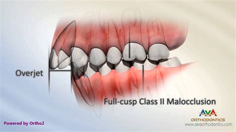 Class 2 Div 1 Malocclusion