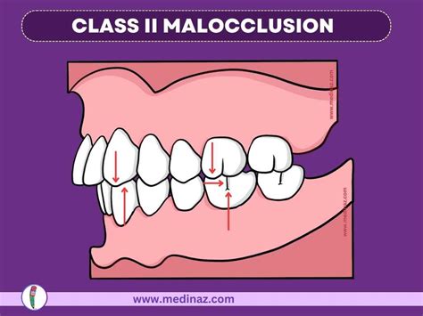Class 2 Malocclusion