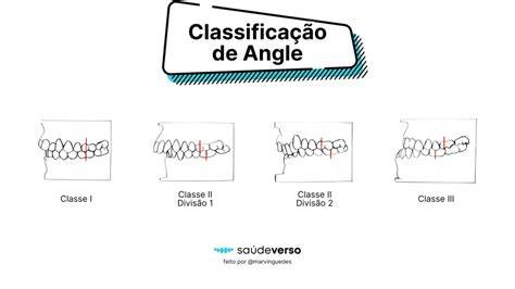 Classificacao De Angle