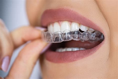 Clear Aligners Cost