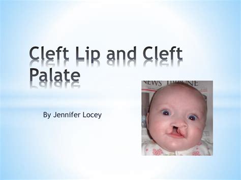 cleft lip and palate awareness.pptx - SlideShare