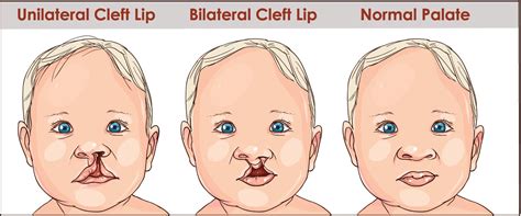 Cleft Lip Definition