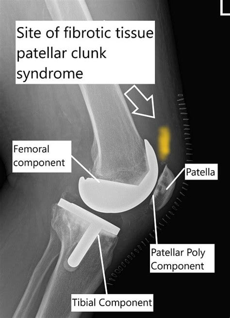 clunking in knee when walking