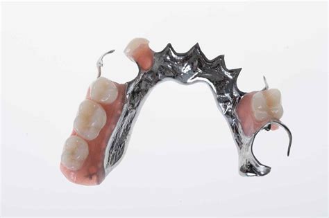 Cobalt Chrome Denture