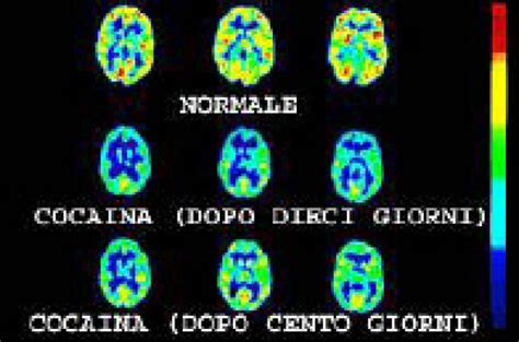 Cocaina Focus