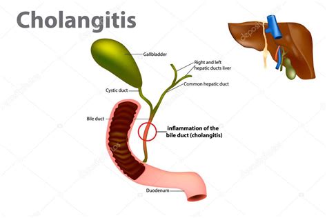 colangitis - hipertension portal