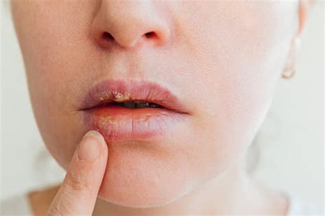 Cold Sores Herpes Simplex Fever Blisters Treated With Homeopathy Acupressure And Schuessler Salts Cell Salts A Homeopathic Naturopathic And Biochemical Guide