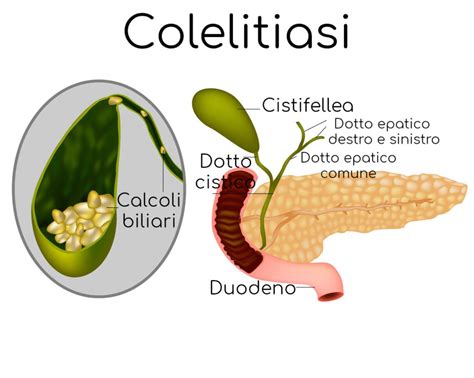 colecistite cronica cure