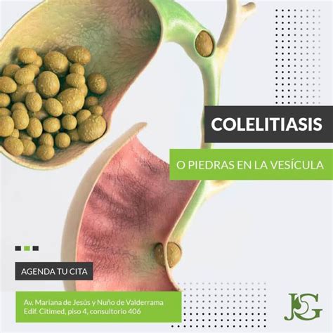 colelitiasis