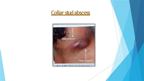Collar Stud Abscess