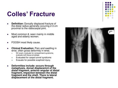 Colles Fracture Ppt