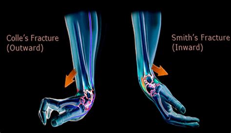 Colles Vs Smith Fracture
