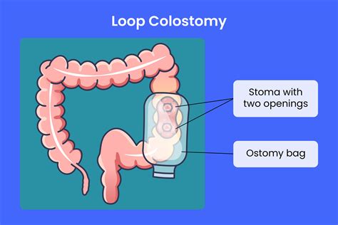 Colon In Loop