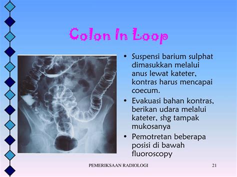 Colon In Loop Adalah