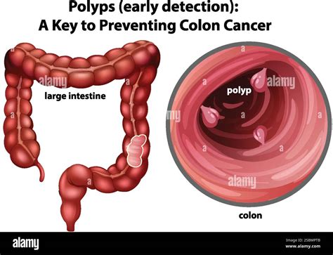 Colon Polyps Icd 10