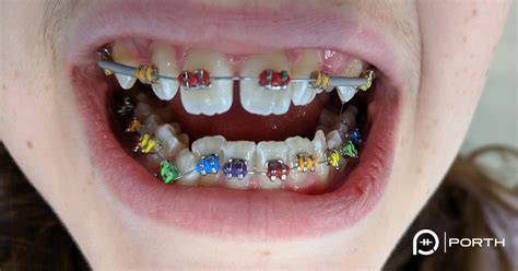 colored braces