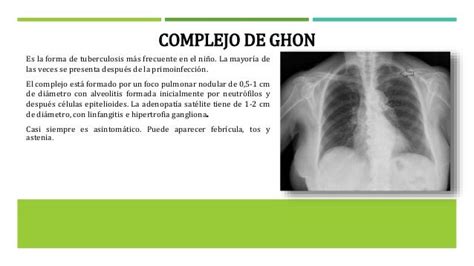Complejo De Ghon