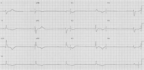 Complete Heart Block Ecg