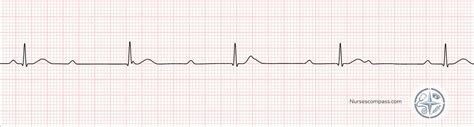 Complete Heart Block Icd 10