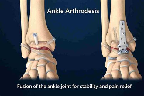 Complex Ankle Arthrodesis Using The Ilizarov Method Yields