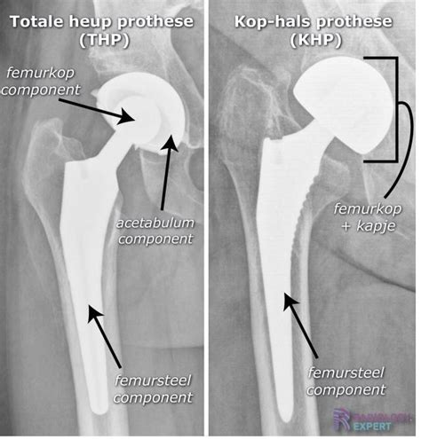 complicaties heupprothese