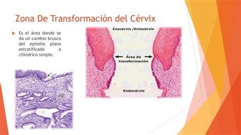 Componente Endocervical Zona De Transformação Presente