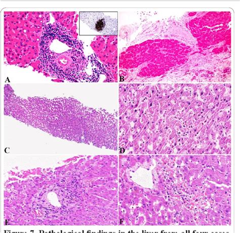 Download Comprehensive Review Of Histopathological Findings Of 