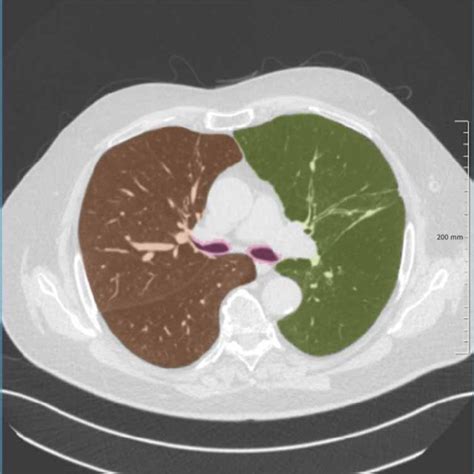 Computed Tomography Of The Lung A Pattern Approach Medical Radiology