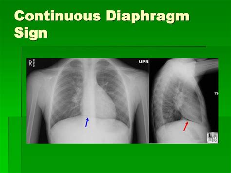 Continuous Diaphragm Sign