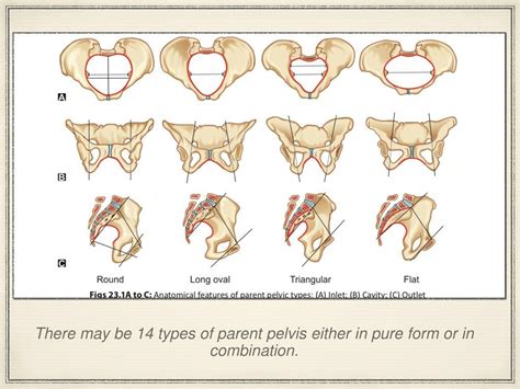 Contracted Pelvis Definition