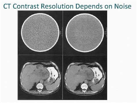Contrast Resolution Ct