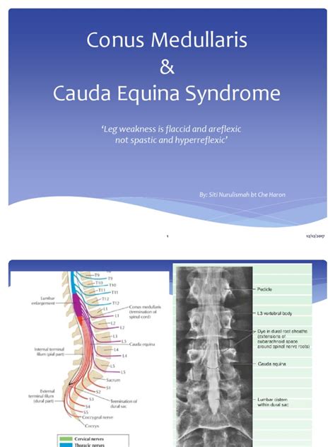 conus medullaris syndrome pdf