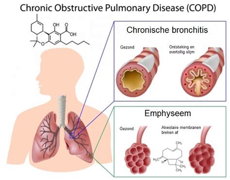 copd behandeling