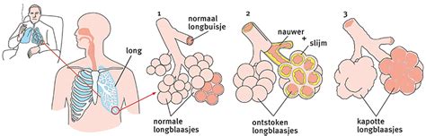 copd longziekte engels