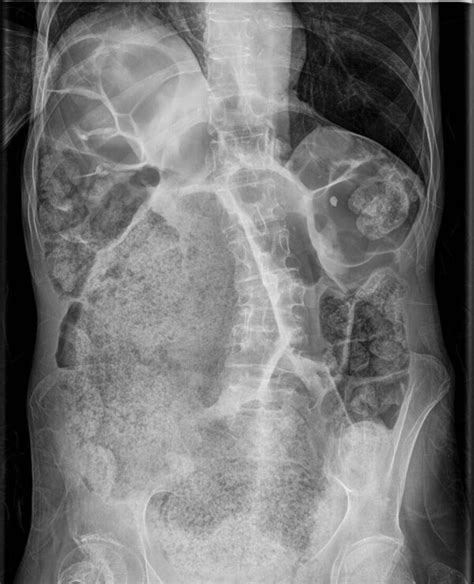 Coprostasis Que Es
