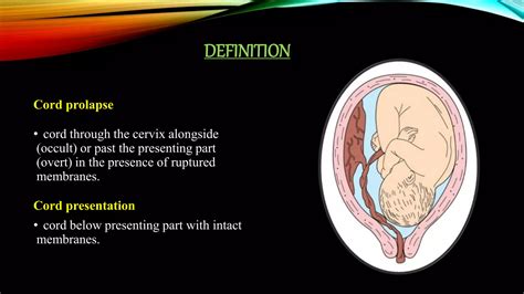 Cord Prolapse Ppt