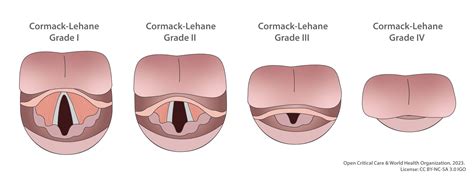 Cormack Lehane Grading