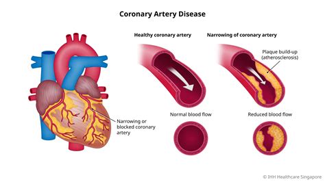 coronary heart disease 뜻