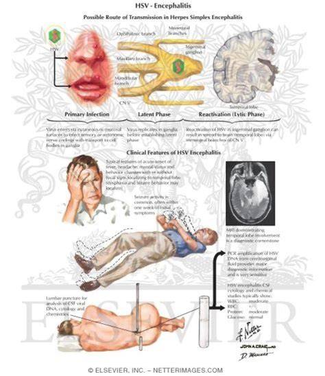Corticosteroid Use Hsv Encephalitis