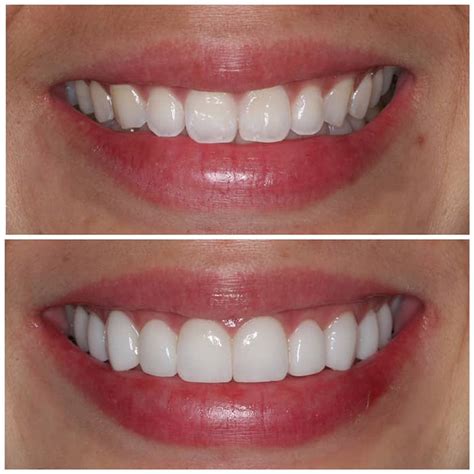 cost? - Lumineers Dental Veneers #1 Patient-Requested …